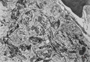 Whipple disease Whipple disease